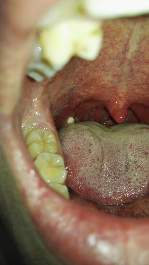 口腔白色东西是什么?需警惕哪些疾病?