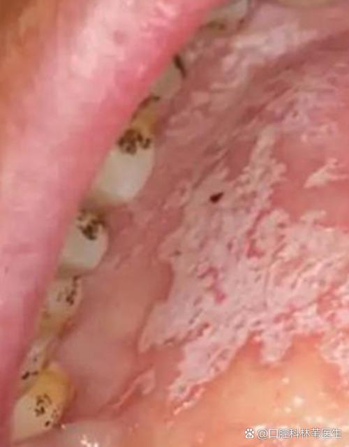 口腔白色东西是什么?需警惕哪些疾病?