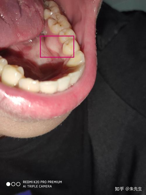 口腔内侧凸起肉包是何原因?