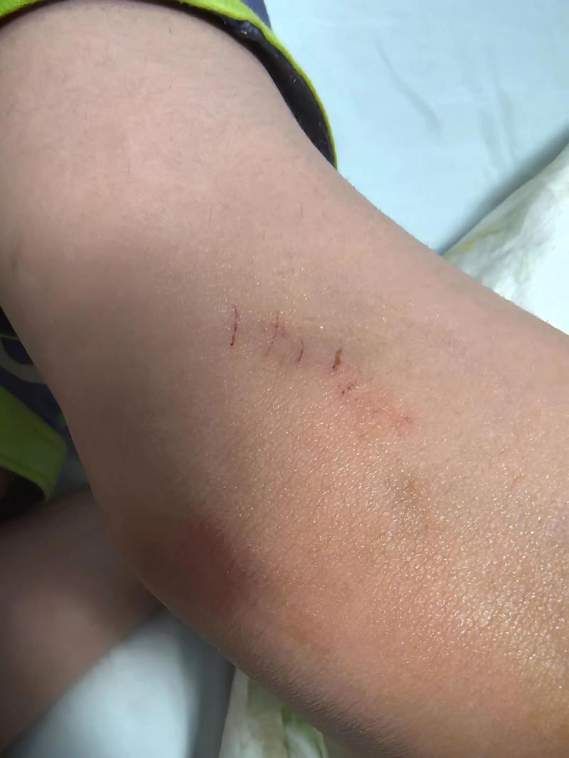 皮肤一划就留痕，是身体发出的什么信号？