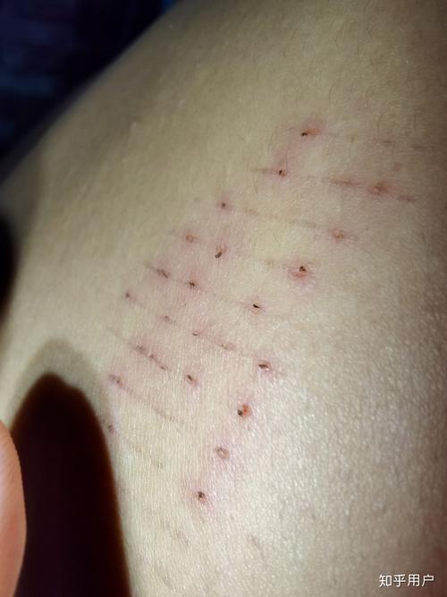 皮肤一划就留痕,是身体发出的什么信号?