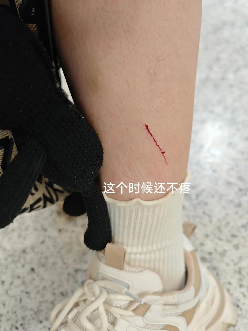 皮肤一划就留痕,是身体发出的什么信号?