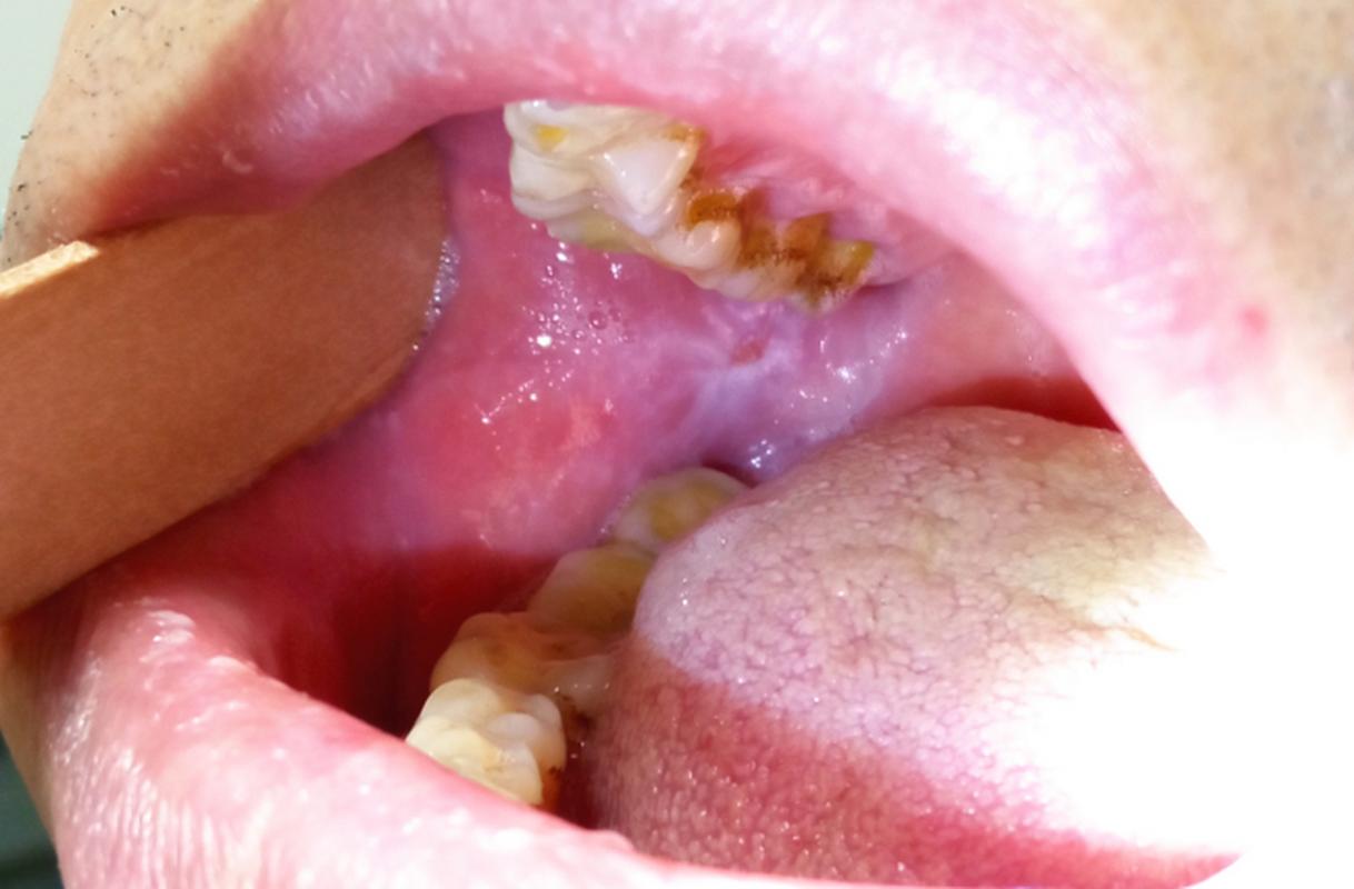 口腔颊膜炎症状图片有哪些表现？