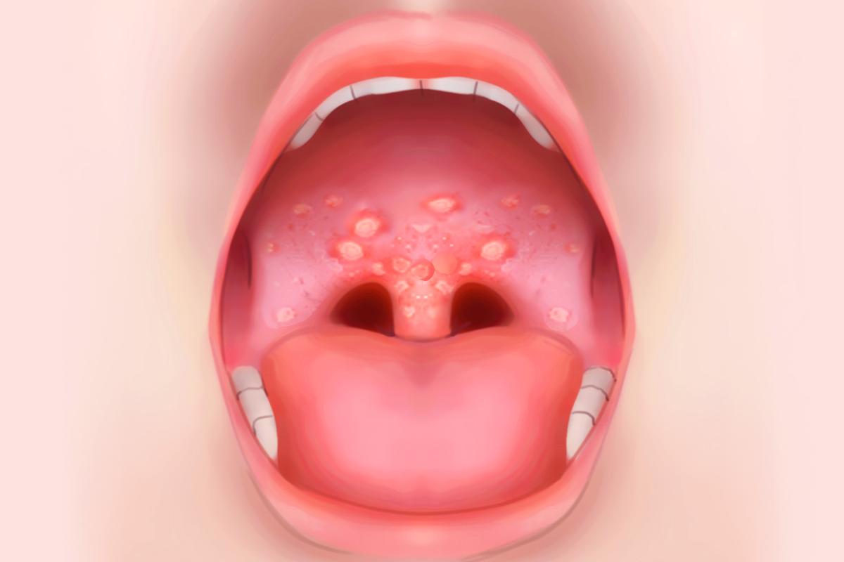 口腔颊膜炎症状图片有哪些表现?