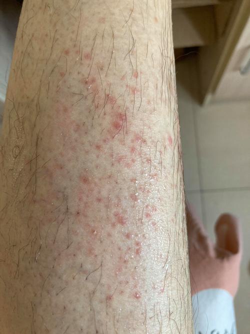 腿上皮肤一直痒，是啥问题？