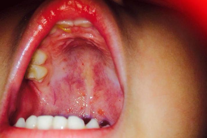 口腔上火有哪些典型症状?