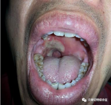 白塞氏病口腔溃疡长啥样?图片能识别吗?