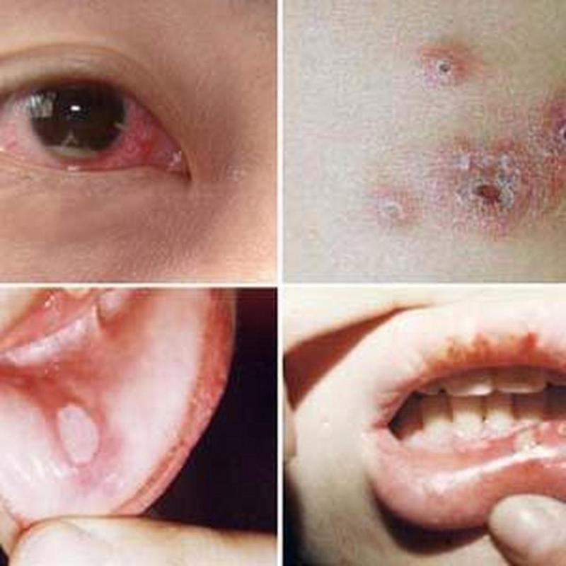 白塞氏病口腔溃疡长啥样?图片能识别吗?