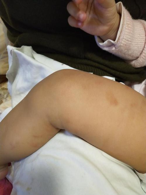 婴儿皮肤为何粗糙一块一块？