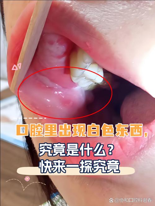 口腔内臭白色东西是什么？