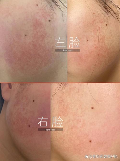 脸颊两侧鸡皮肤怎么快速改善？