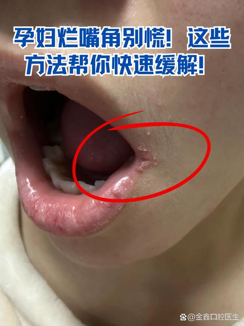 口腔皮下气肿怎么处理?