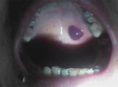 口腔内壁黑疙瘩是何问题?需警惕吗?