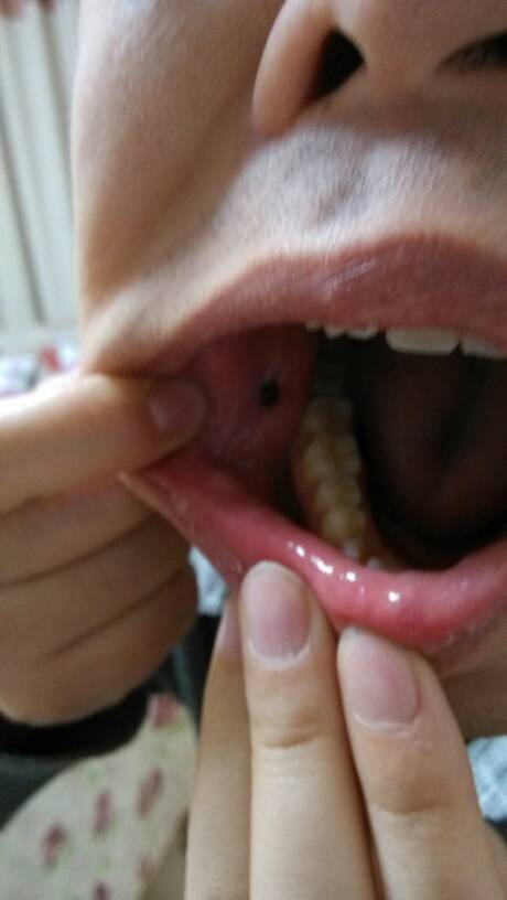 口腔内壁黑疙瘩是何问题？需警惕吗？