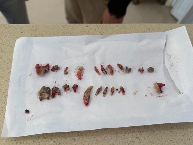 拔完牙牙洞有食物残渣怎么办？