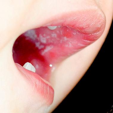 槟榔致口腔发白是癌前病变吗？