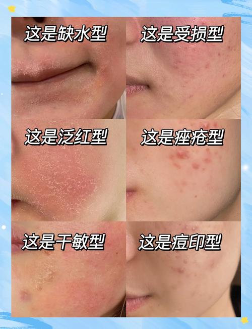 脸上皮肤痒红是过敏还是皮肤问题？