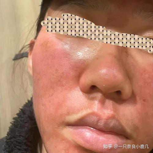 吃异维A酸皮肤真的会变好吗？