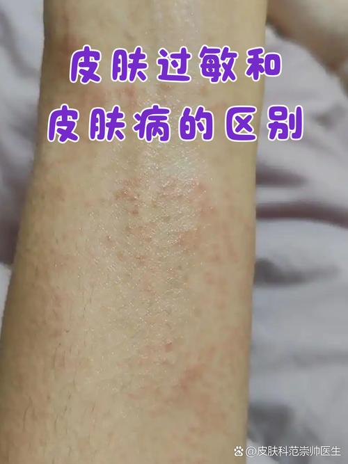 过敏性皮肤病图片大全能自诊吗？