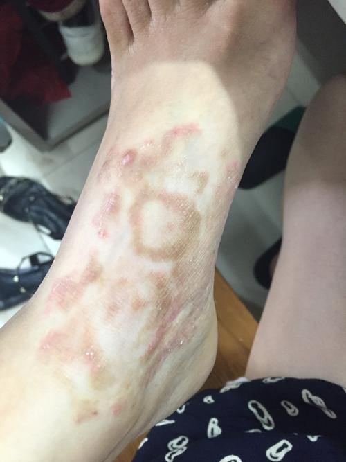 脚背皮肤痒是啥原因引起的？