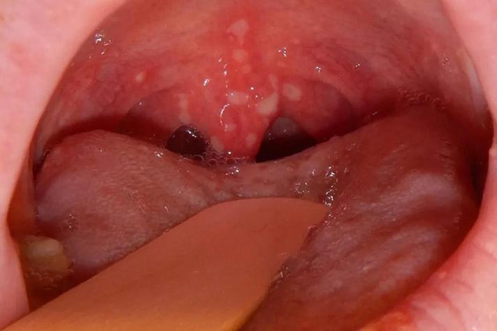 宝宝口腔上颚有小疙瘩是啥原因？