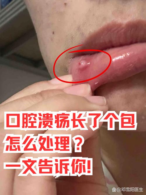 口腔疼无溃疡，是啥问题？