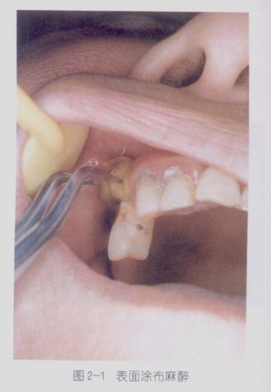 口腔麻药影响胎儿吗？