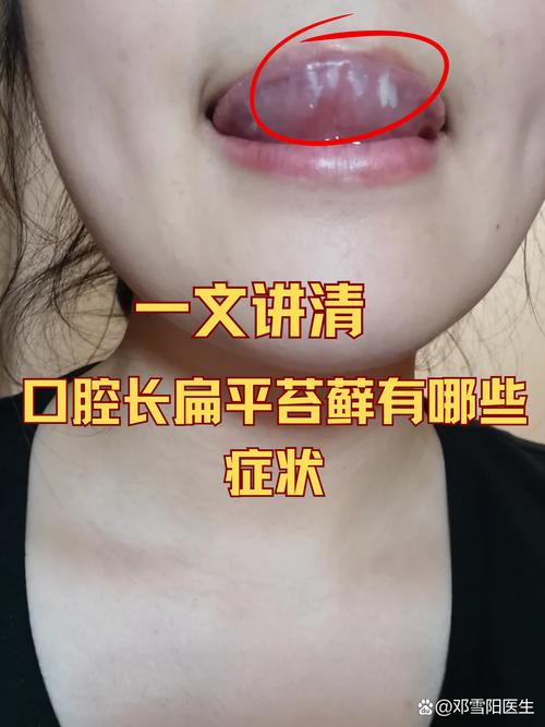 口腔扁平苔藓真的可以放任不管吗？