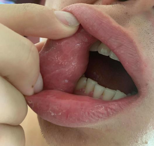 口腔小米粒疙瘩是啥？图片对照看懂不？