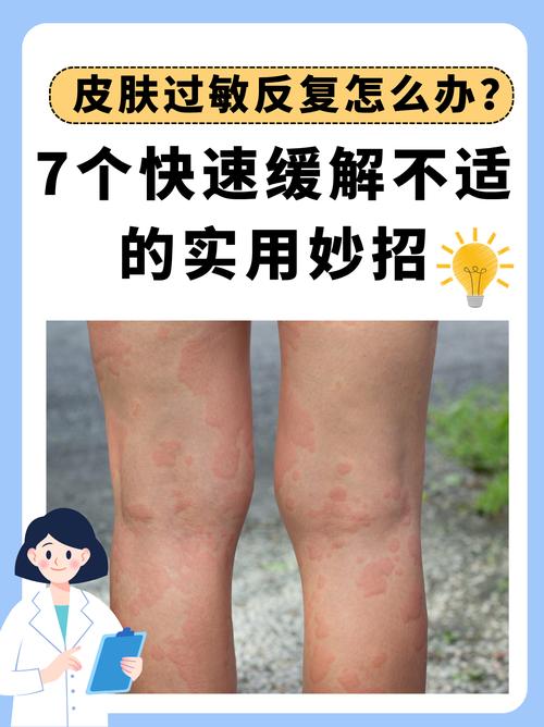 皮肤过敏能吃酸奶吗?会加重吗?