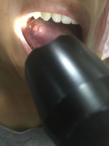 口腔侧壁有个黑色疙瘩