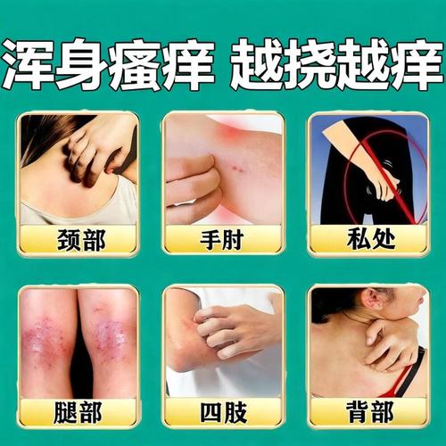 冬季皮肤痒，选什么药膏最有效？