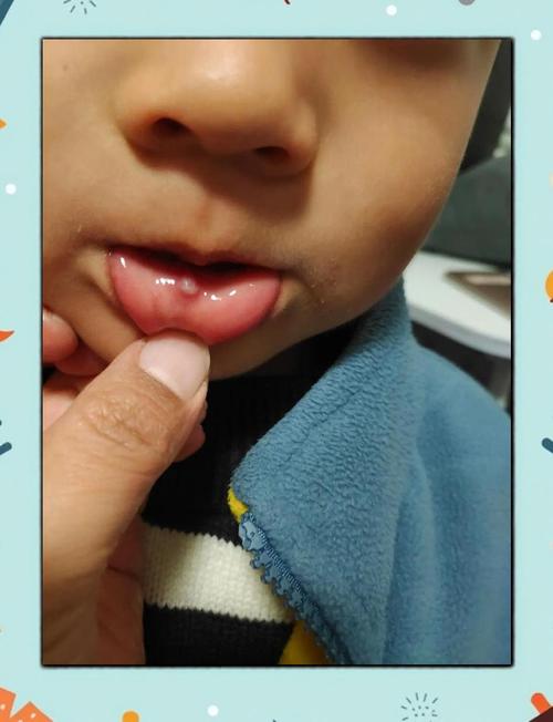 口腔粘液腺囊肿自愈吗