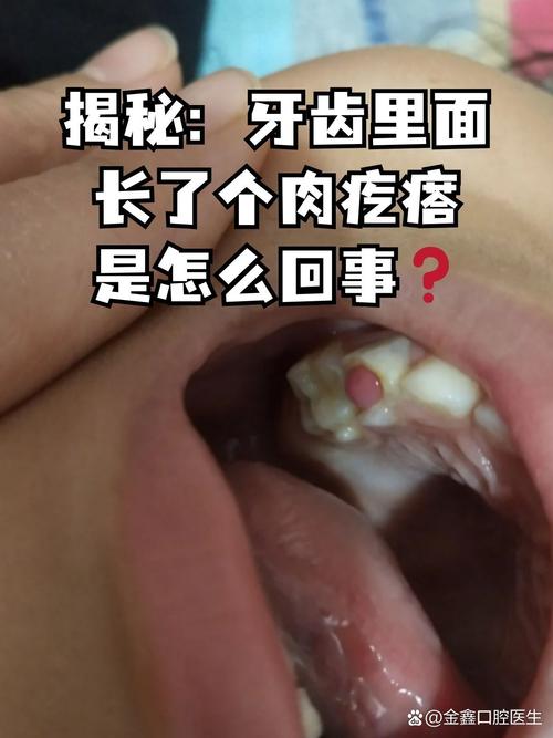 口腔最里面长牙齿是智齿还是异常？