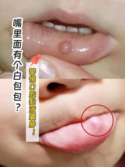 口腔腺体囊肿能自行消退吗？