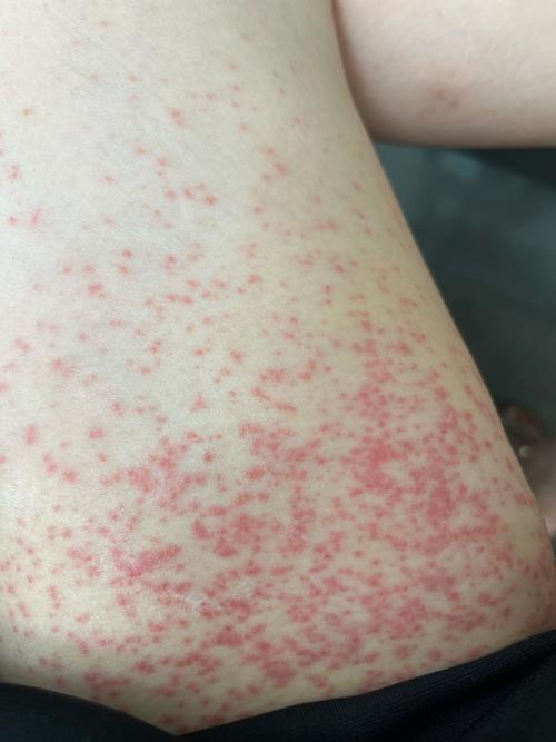 冬天皮肤痒起红疹，是过敏还是缺水？