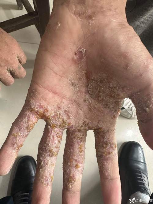 甲醇沾皮肤会中毒吗？