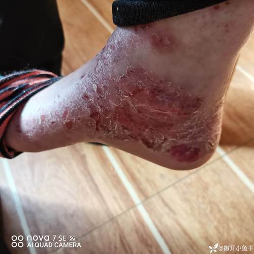 甲醇沾皮肤会中毒吗?