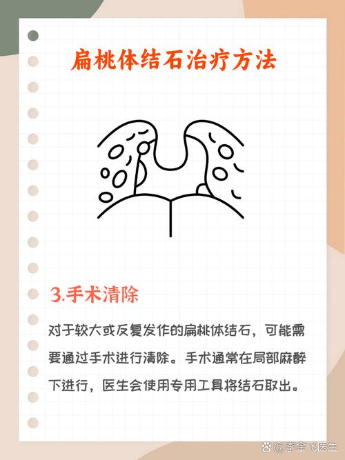 口腔里的结石怎么处理