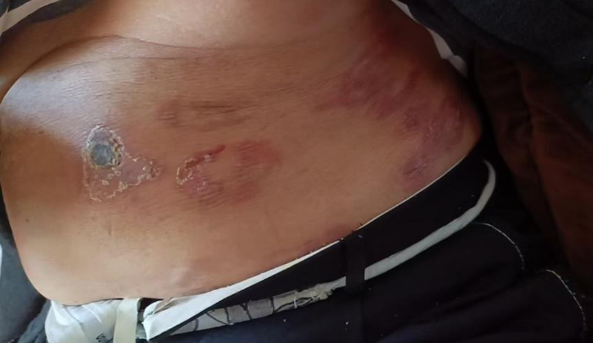 皮肤淋巴瘤的症状图片