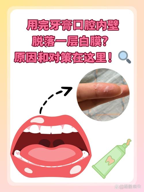 口腔白皮脱落是何原因？
