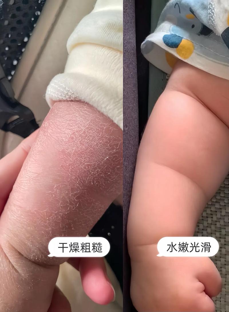 婴儿皮肤粗糙什么原因