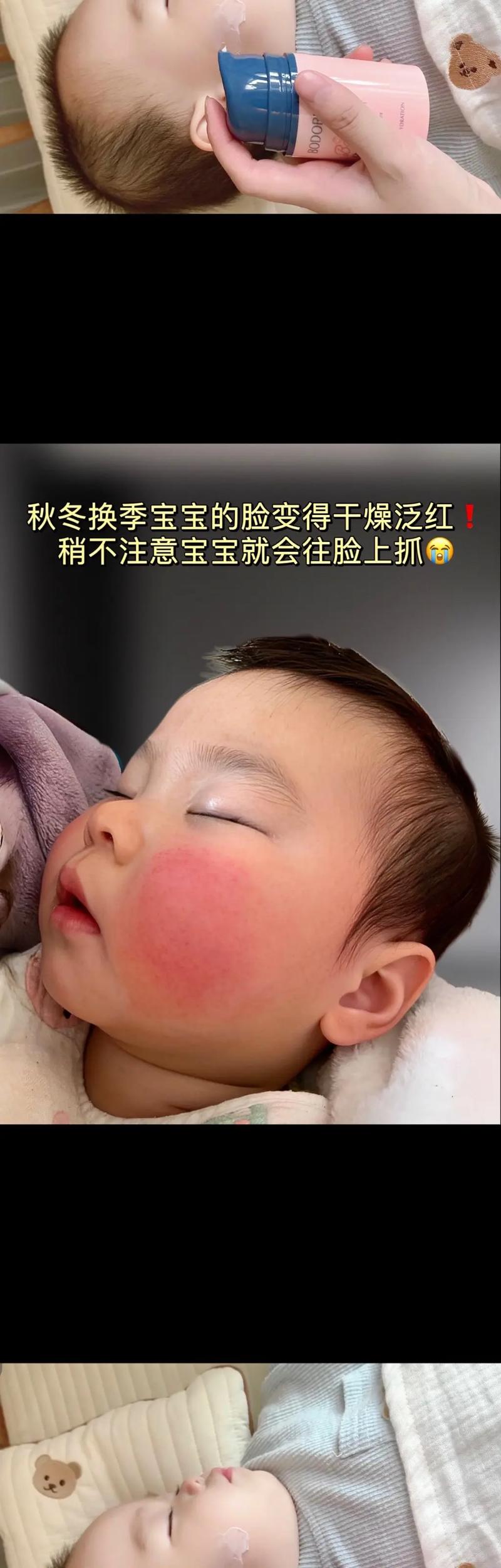 婴儿皮肤粗糙什么原因