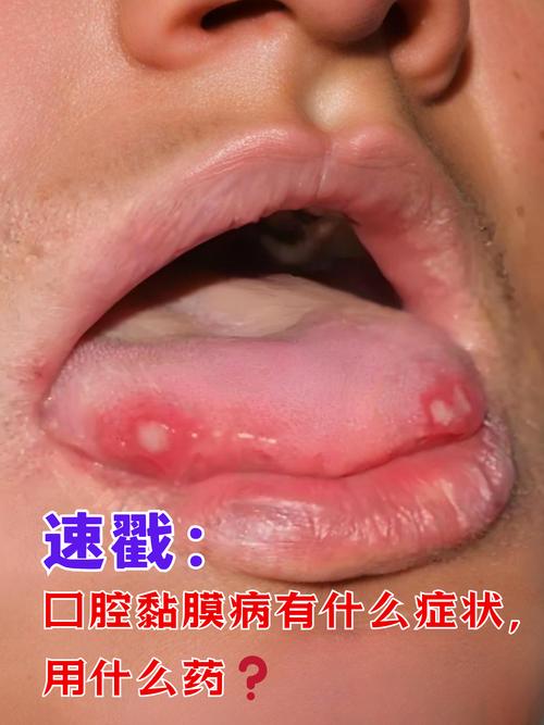 口腔病竟会引发哪些全身疾病?