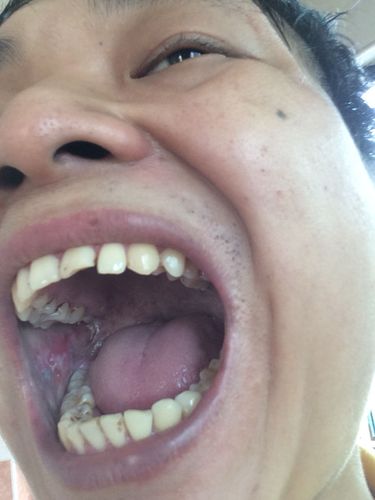 口腔右边白线条是何病兆?