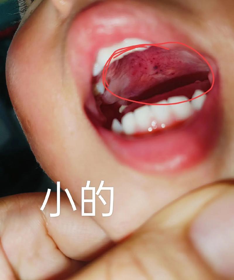 小儿口腔疱疹高烧不退怎么办?