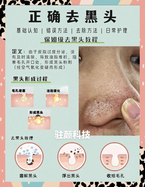 医院皮肤科能去黑头吗