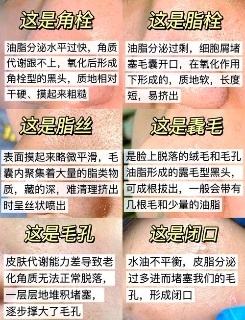 医院皮肤科能去黑头吗