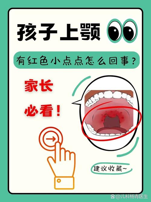 儿童口腔上颚红斑是何原因?