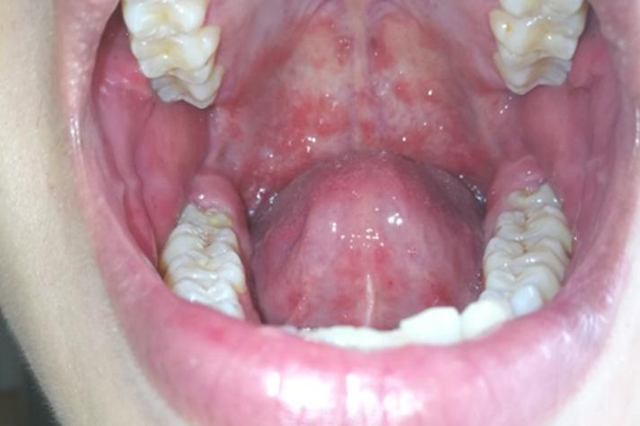 儿童口腔上颚红斑是何原因?